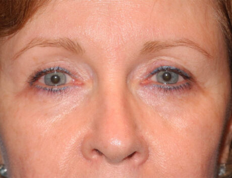 Blepharoplasty case #6466