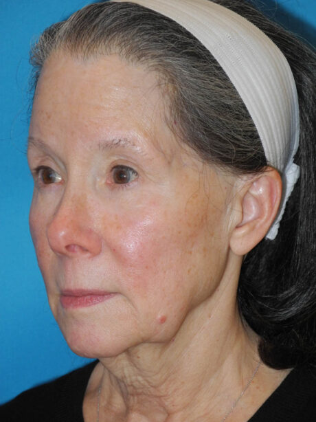 Facelift case #5457