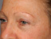 Blepharoplasty case #5153