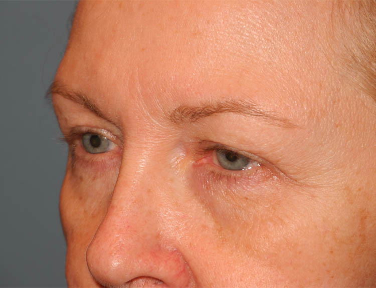 Blepharoplasty case #4986