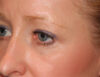 Blepharoplasty case #6465