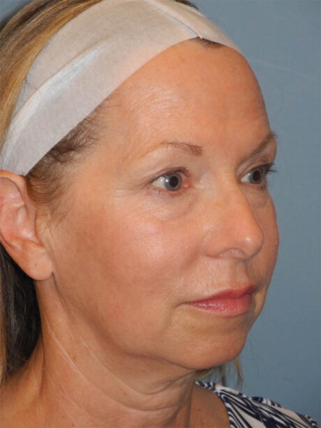 Blepharoplasty case #4966