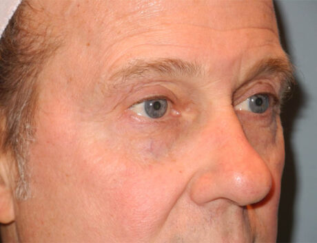 Blepharoplasty case #6464