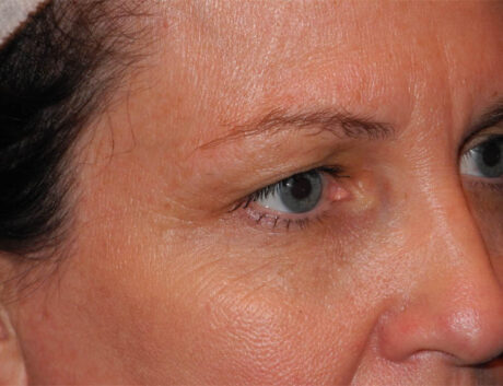 Blepharoplasty case #4960