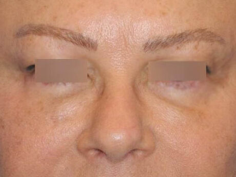 Blepharoplasty case #3989