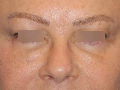 Blepharoplasty case #3989