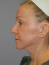 CO2 Laser Resurfacing case #4681