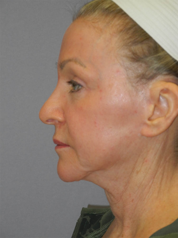 CO2 Laser Resurfacing case #4681