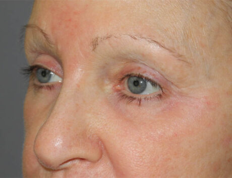 Blepharoplasty case #5153