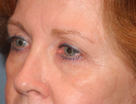 Blepharoplasty case #6466