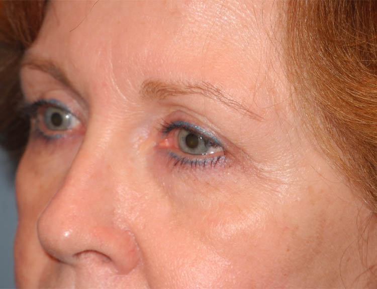 Blepharoplasty case #4986