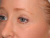 Blepharoplasty case #6465