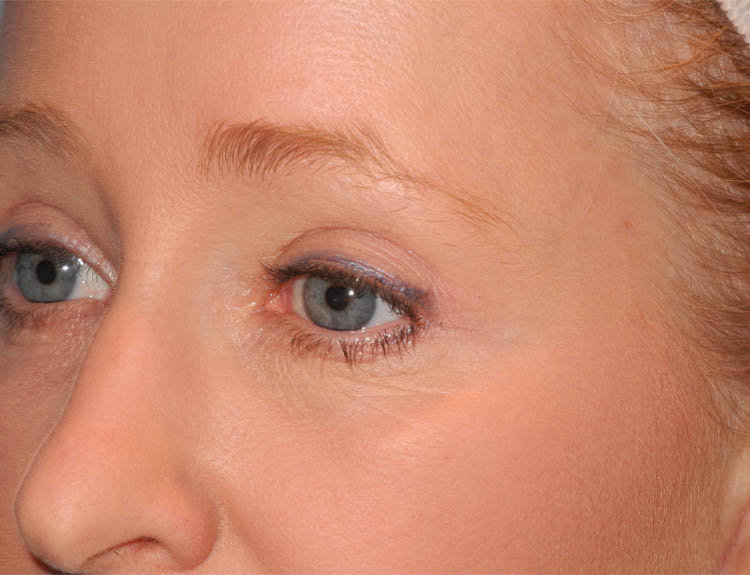 Blepharoplasty case #5003