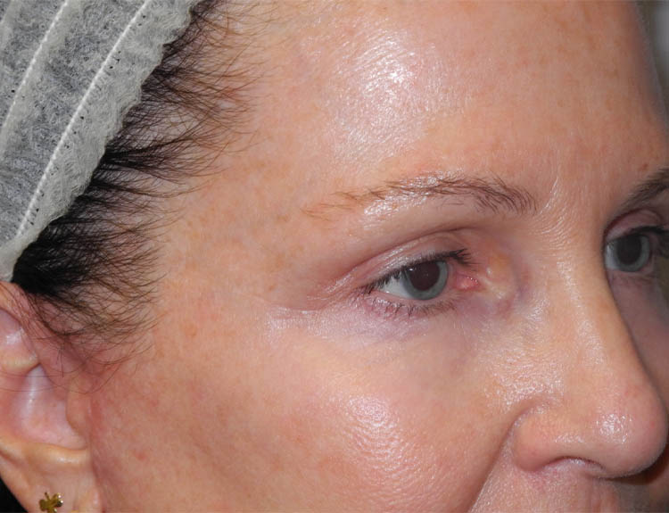 Blepharoplasty case #4960