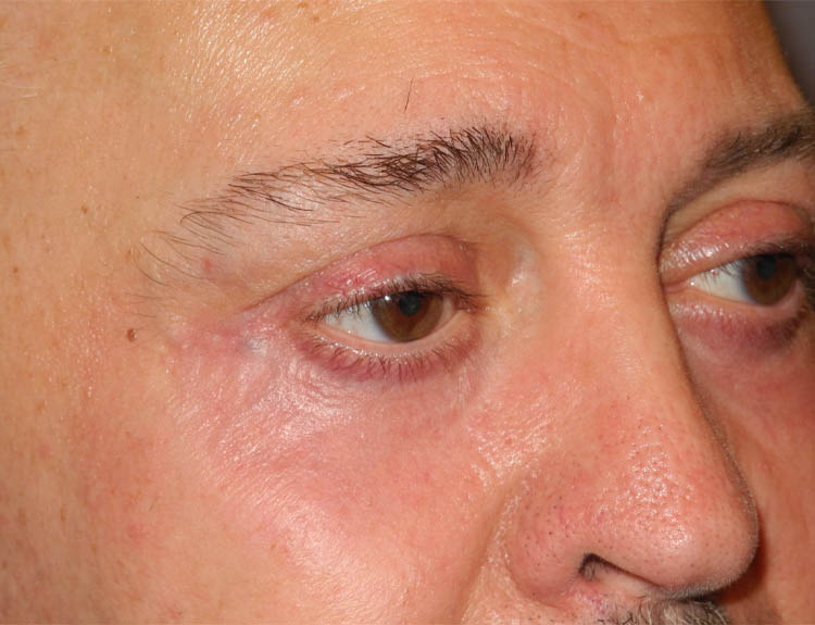 Blepharoplasty case #5148