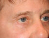 Blepharoplasty case #6464