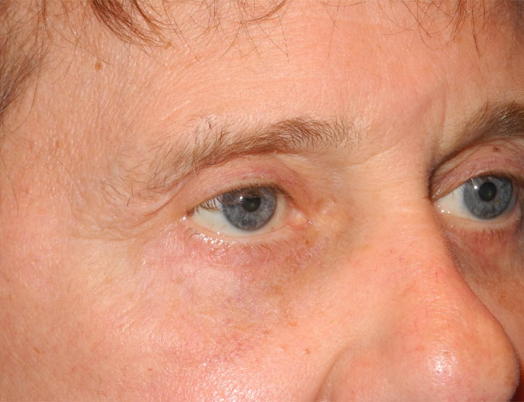 Blepharoplasty case #5018