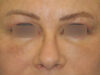 Blepharoplasty case #3989