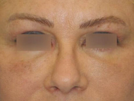 Blepharoplasty case #3989