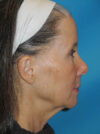 Facelift case #5457