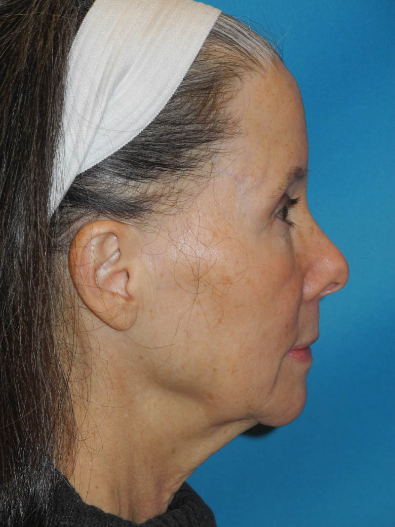 Facelift case #5457