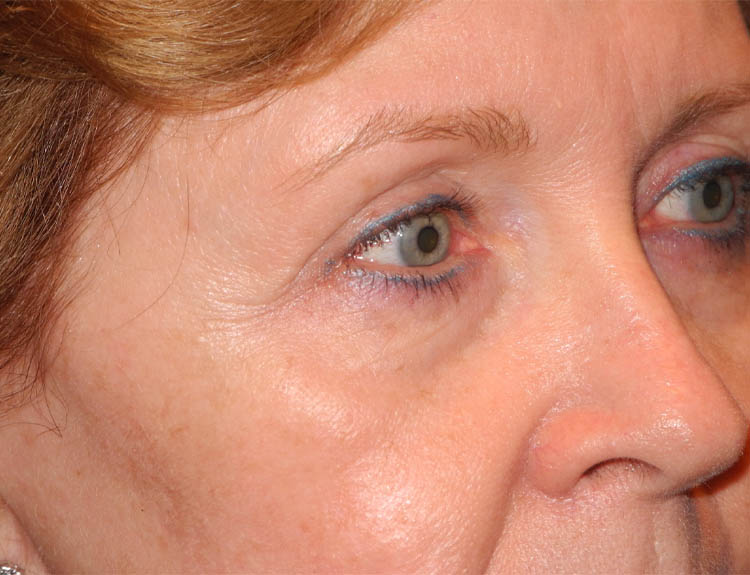 Blepharoplasty case #6466