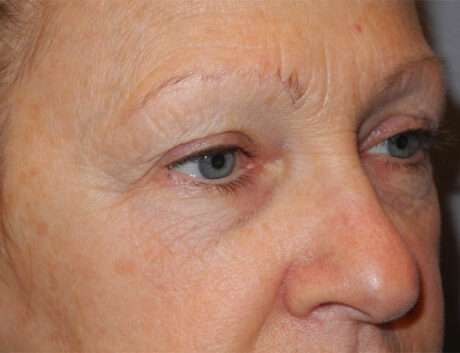 Blepharoplasty case #5153