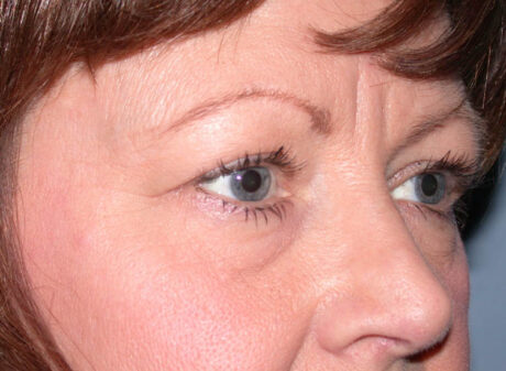 Blepharoplasty case #4819