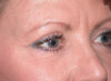 Blepharoplasty case #4819