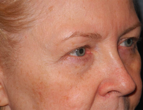 Blepharoplasty case #6466