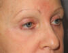 Blepharoplasty case #5153