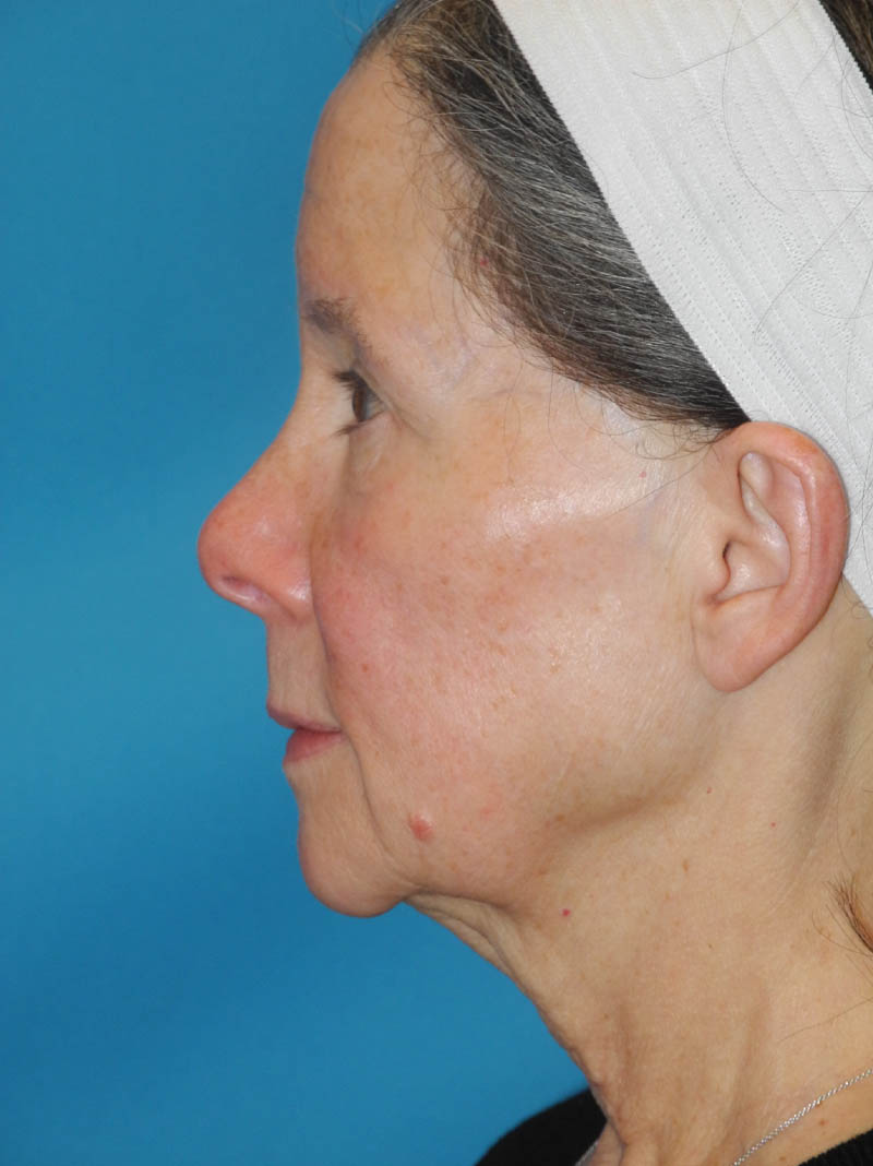 Facelift case #5457