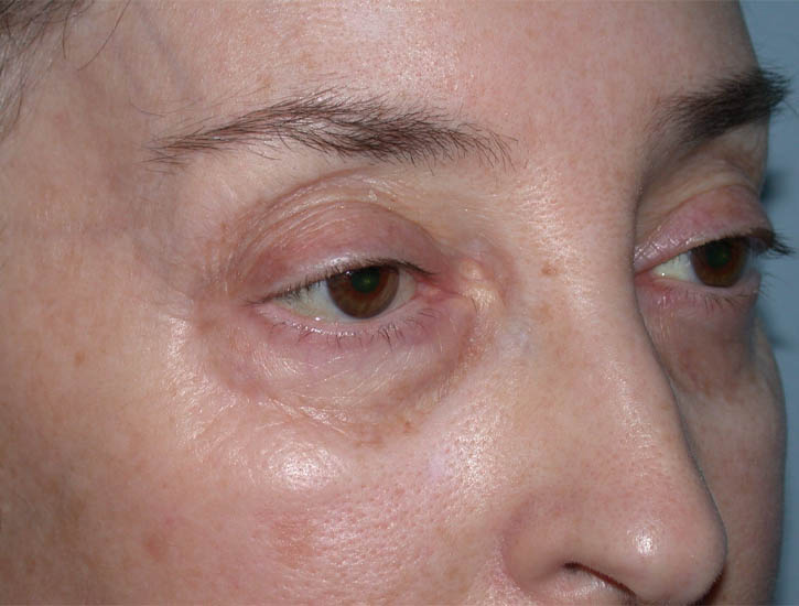 Blepharoplasty case #4858