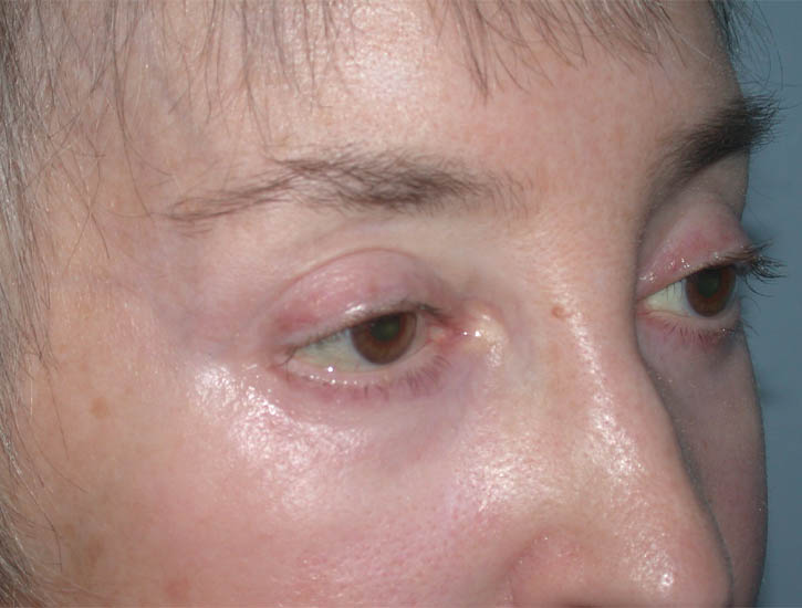 Blepharoplasty case #4858