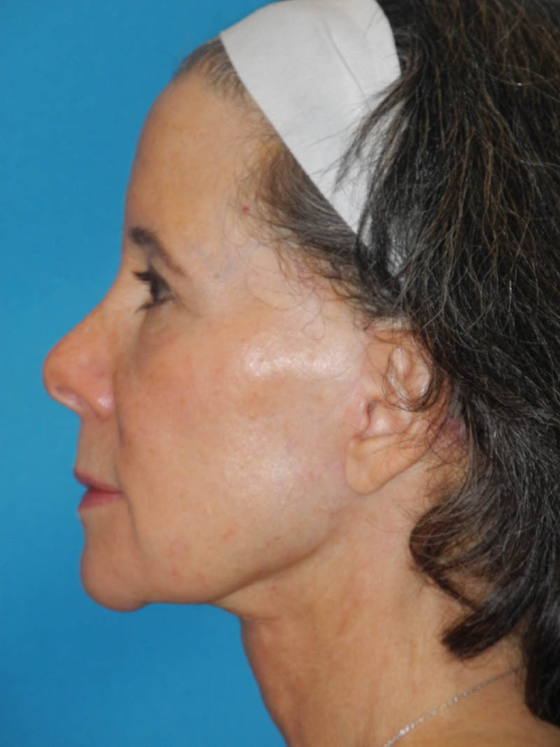 Facelift case #5457