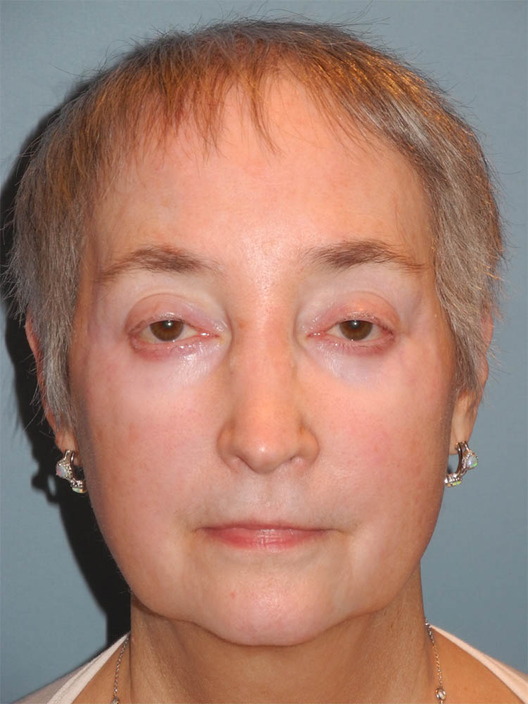 Blepharoplasty case #4858