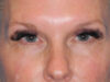 Blepharoplasty case #6485