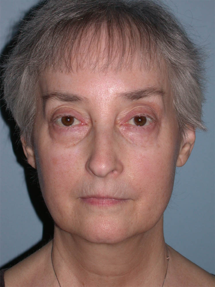 Blepharoplasty case #4858