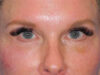 Blepharoplasty case #6485