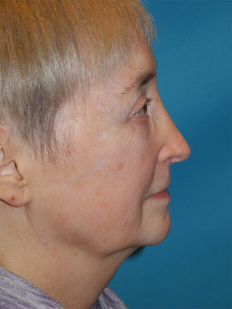 Blepharoplasty case #4858