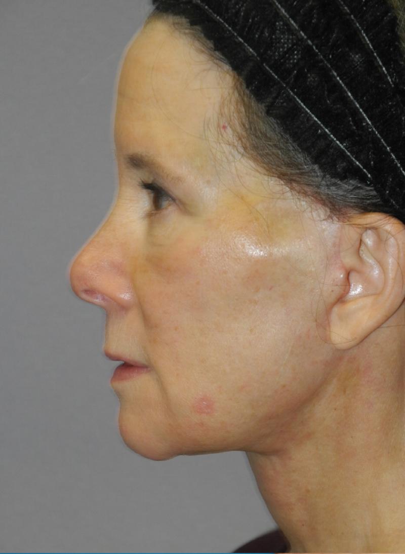 Facelift case #5457