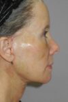 Facelift case #5457