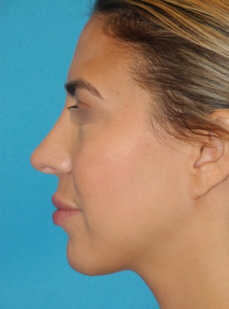 Rhinoplasty case #3805