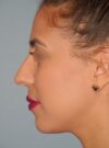 Rhinoplasty case #3805