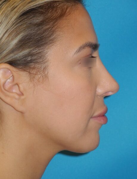 Submental Liposuction case #3807