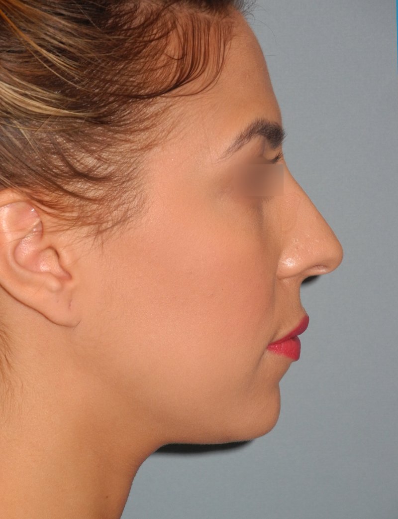 Rhinoplasty case #3805