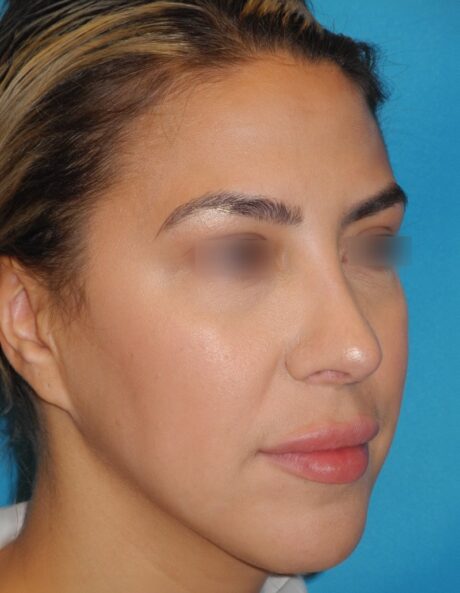 Rhinoplasty case #3805