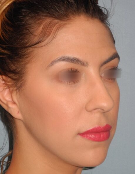 Rhinoplasty case #3805