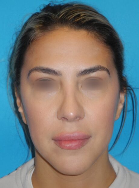 Submental Liposuction case #3807