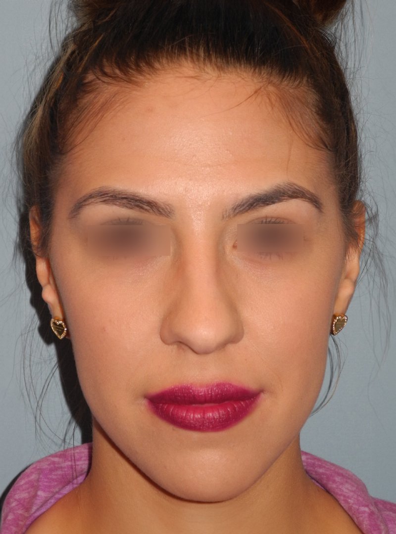 Rhinoplasty case #3805